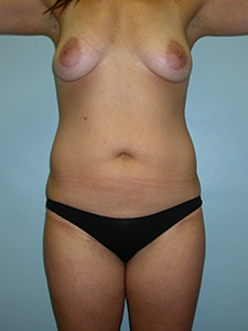 Liposuction before and after - before