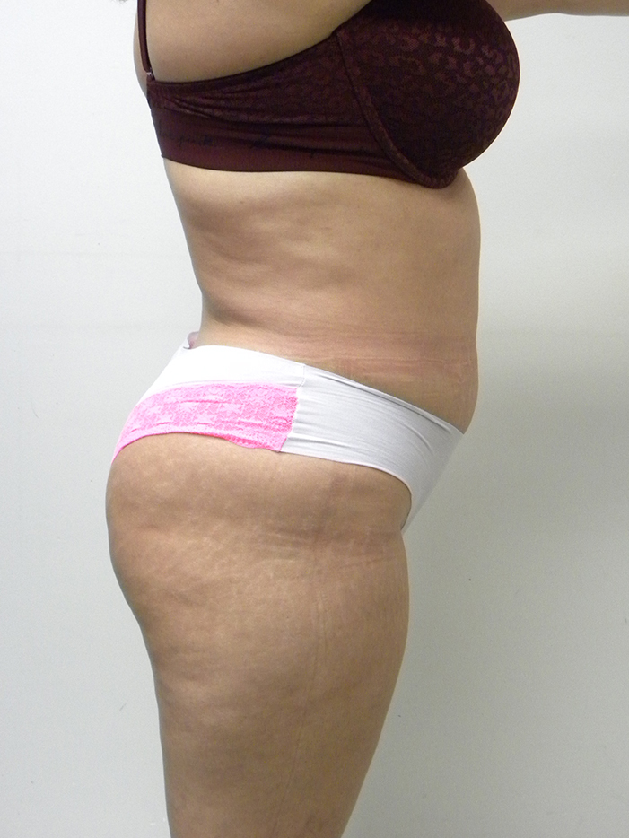 Liposuction before and after - before