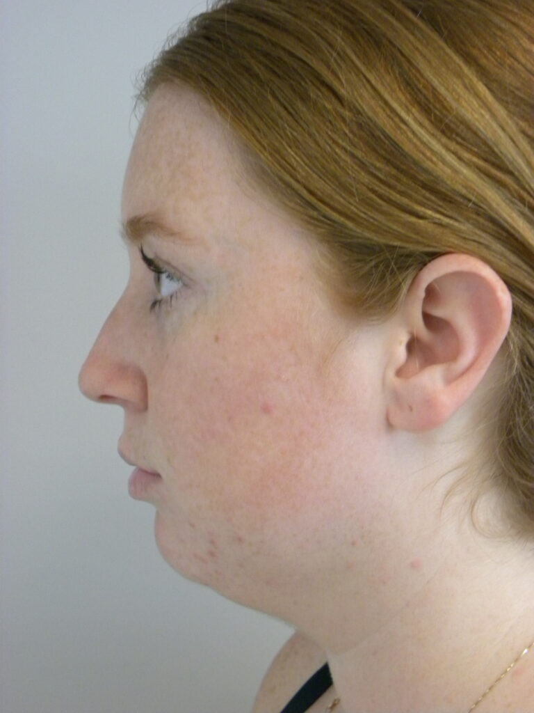 Chin before and after - before