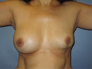 Breast Augmentation before and after - before