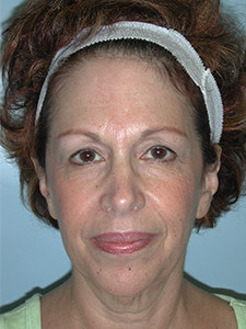 Facelift before and after - before