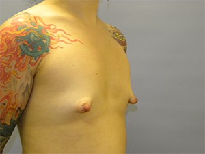 Breast Augmentation before and after - before