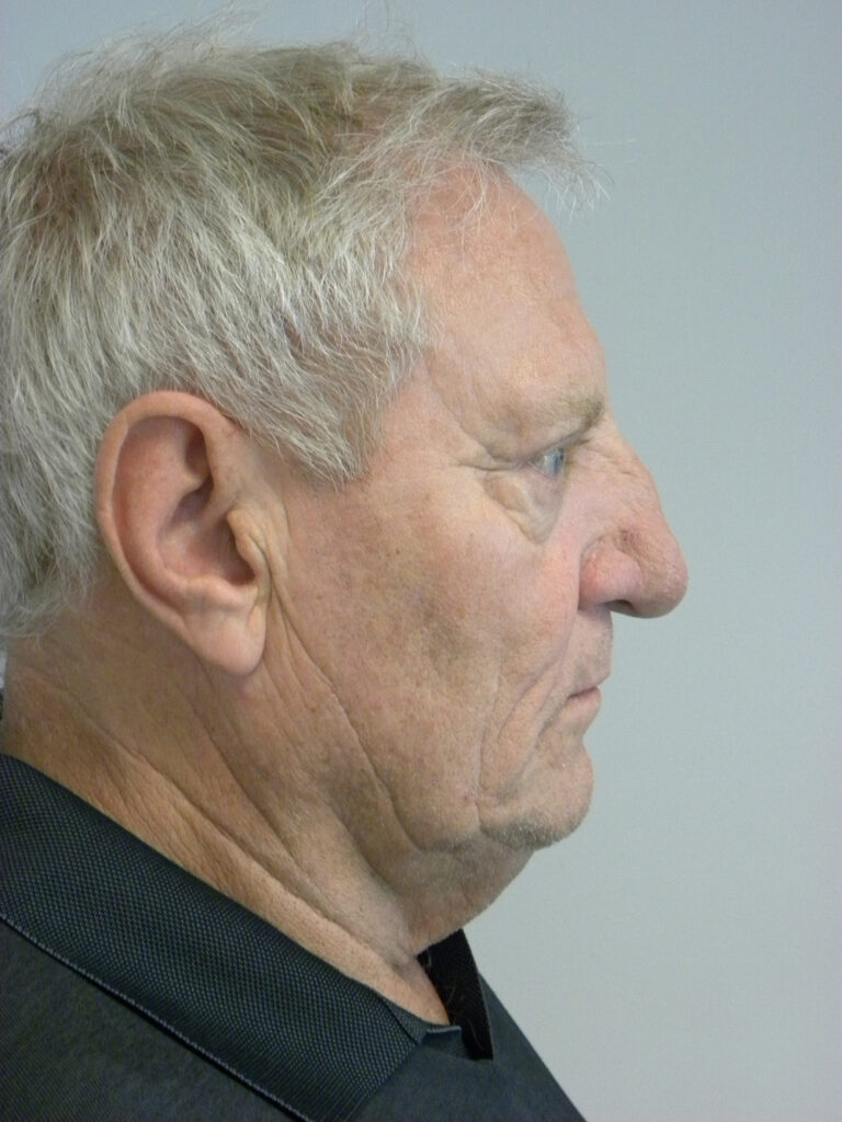 Facelift before and after - before