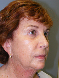Facelift before and after - before