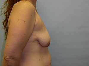 Breast Lift before and after - before