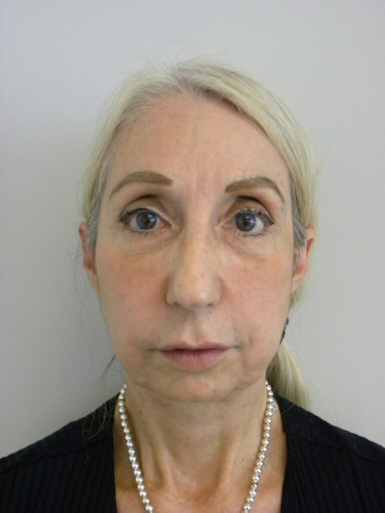 Facelift before and after - before
