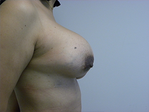 Breast Augmentation before and after - before