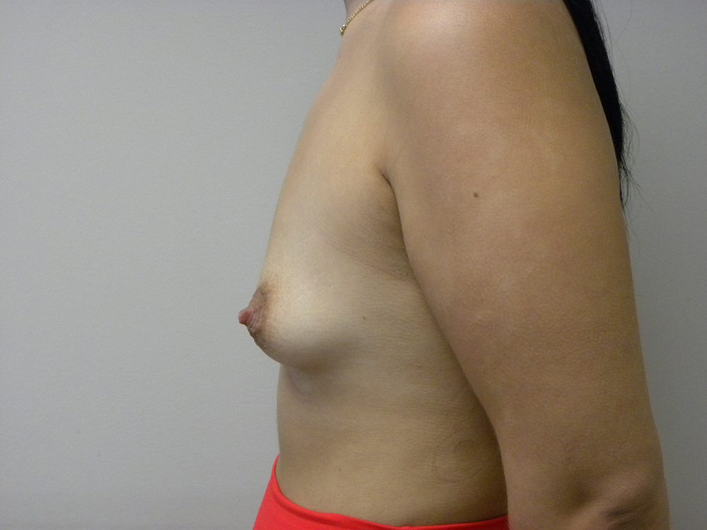 Breast Augmentation before and after - before