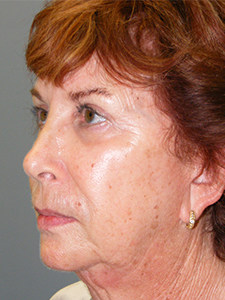 Facelift before and after - before