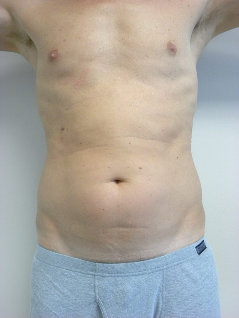 Liposuction before and after - before