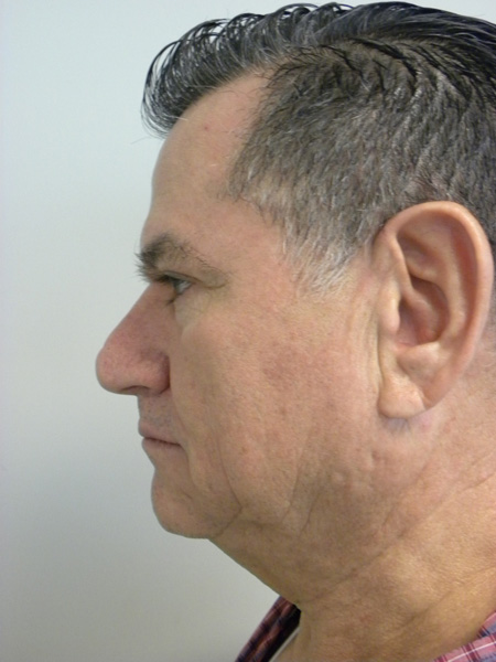 Facelift before and after - before