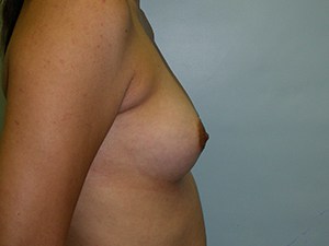 Breast Augmentation before and after - before