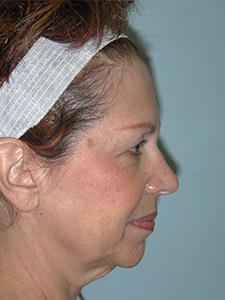 Facelift before and after - before