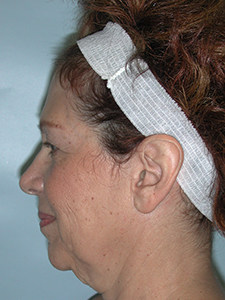 Facelift before and after - before