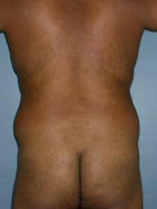 Liposuction before and after - before