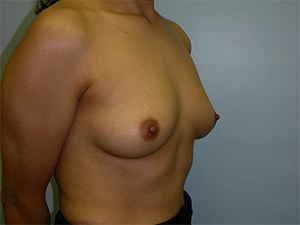 Breast Augmentation before and after - before