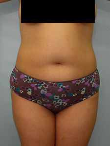 Liposuction before and after - before