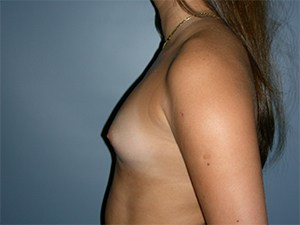 Breast Augmentation before and after - before