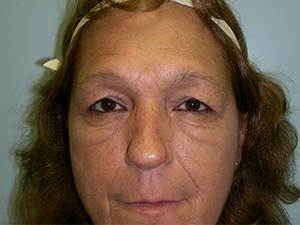 Blepharoplasty before and after - before