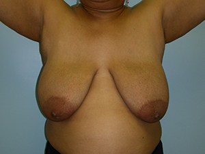 Breast Reduction before and after - before