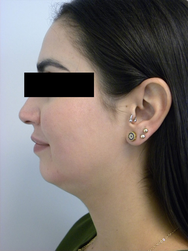 Chin before and after - before