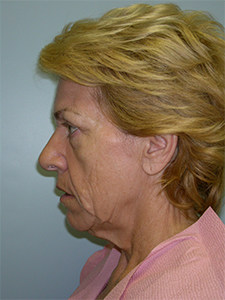 Facelift before and after - before