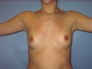 Breast Augmentation before and after - before