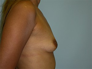 Breast Augmentation before and after - before