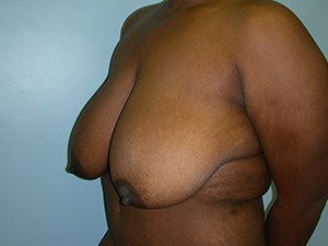 Breast Reduction before and after - before