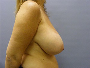 Breast Reduction before and after - before