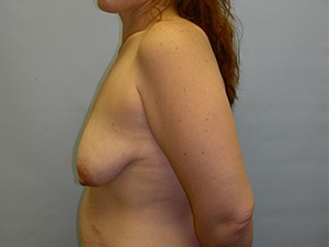 Breast Lift before and after - before