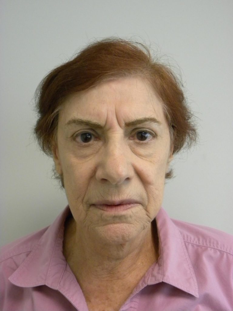 Facelift before and after - before