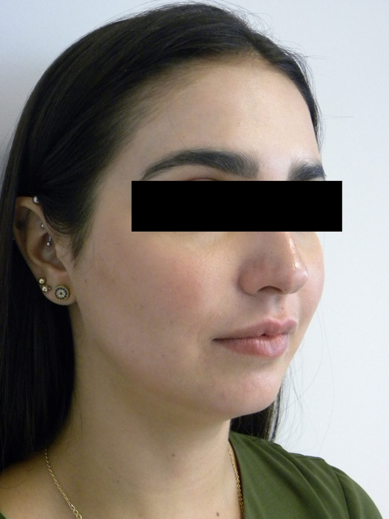 Chin before and after - before