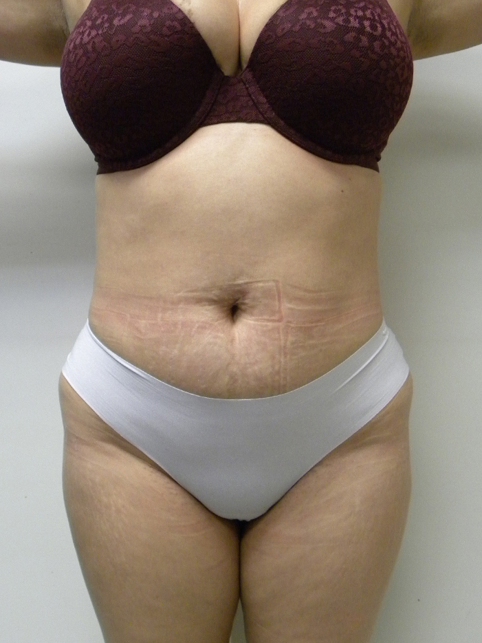 Liposuction before and after - before