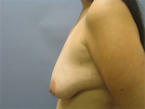 Breast Lift before and after - before