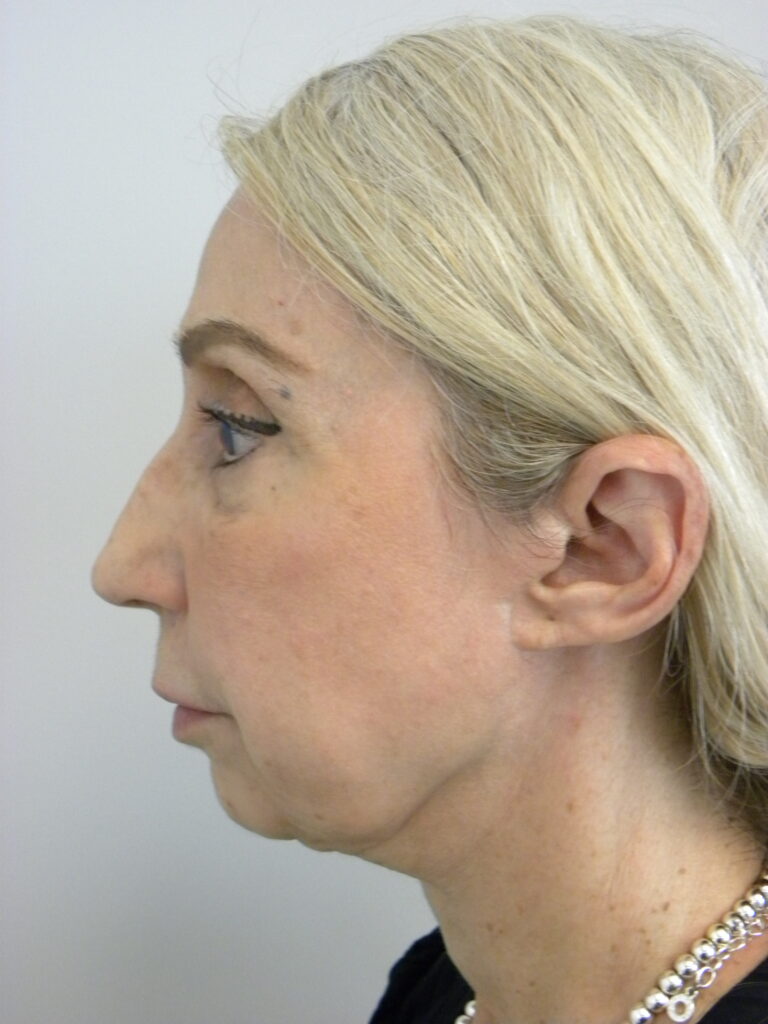 Facelift before and after - before