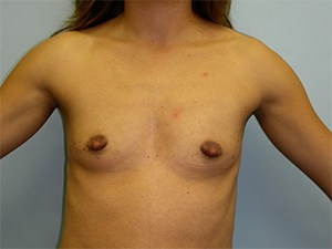 Breast Augmentation before and after - before
