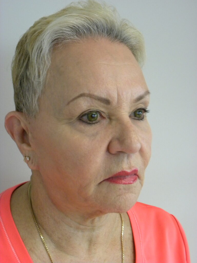 Facelift before and after - before