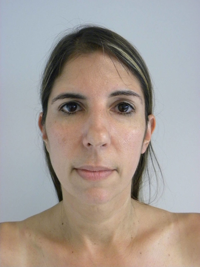 Chin before and after - before