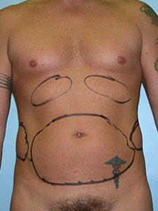 Liposuction before and after - before