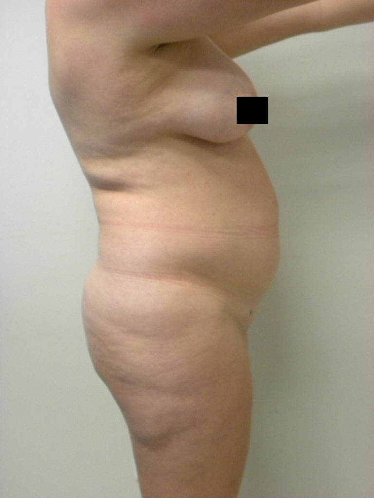 Liposuction before and after - before