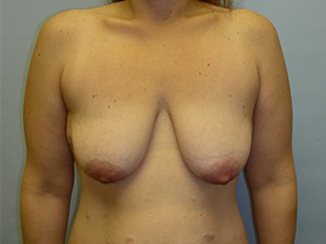 Breast Lift before and after - before