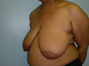 Breast Reduction before and after - before