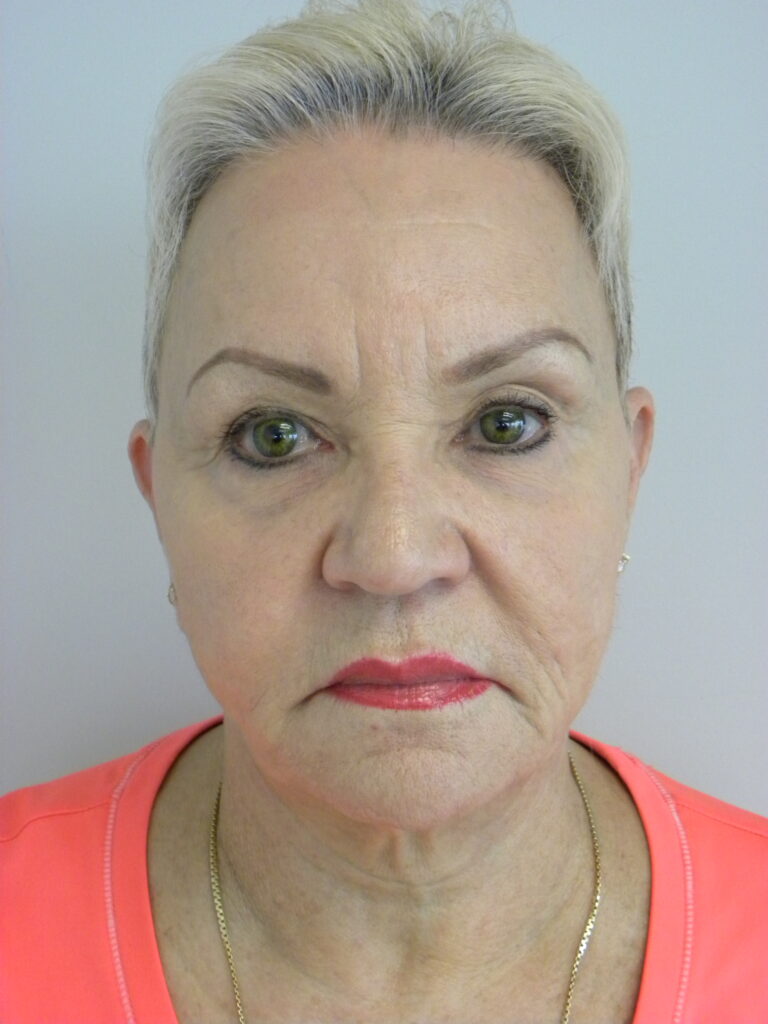 Facelift before and after - before