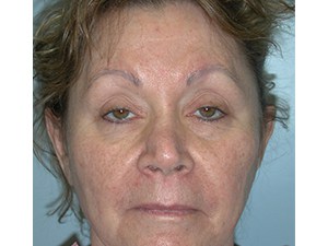 Blepharoplasty before and after - before