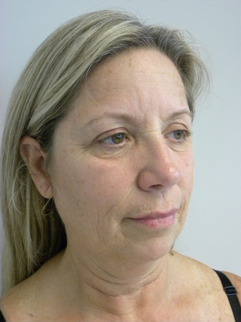 Facelift before and after - before
