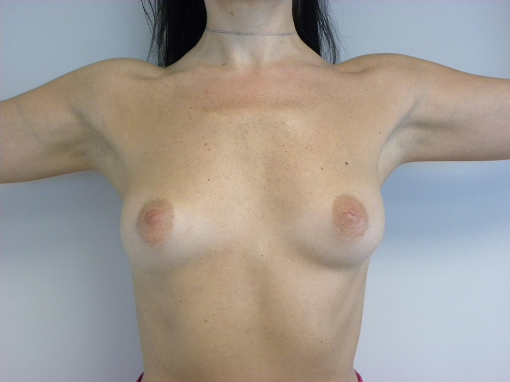 Breast Augmentation before and after - before