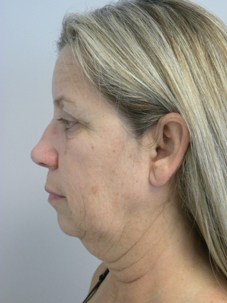 Facelift before and after - before