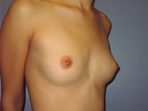 Breast Augmentation before and after - before
