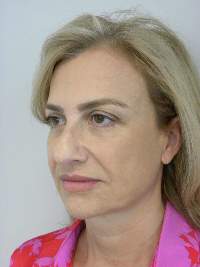 Facelift before and after - before
